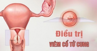 Phương pháp điều trị viêm cổ tử cung triệt để cho chị em